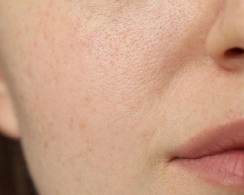 Skin close up of uneven skin tone in need of glow