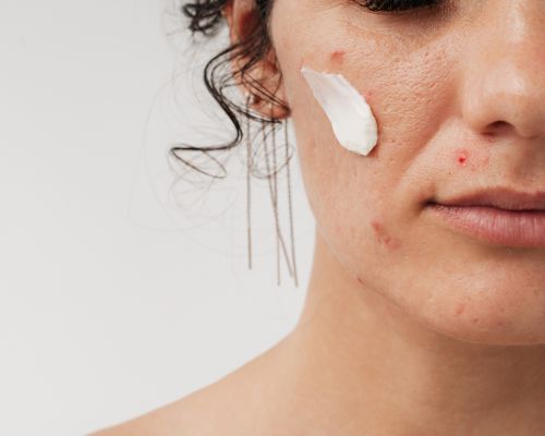 Woman's face with imperfections and a swatch of moisturizer on her cheek