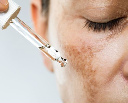 Woman's face with visible hyperpigmentation + dropper with clean skincare to target dark spots