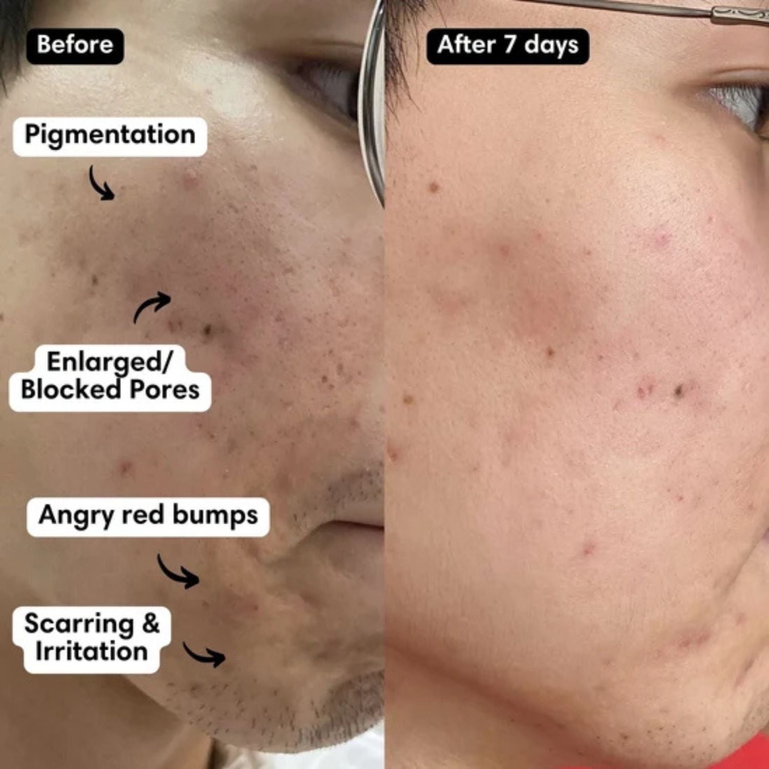 Before and after using the Hot Stone Brightening Mask, visibly reduced pigmentation, pores, breakout, scarring and redness